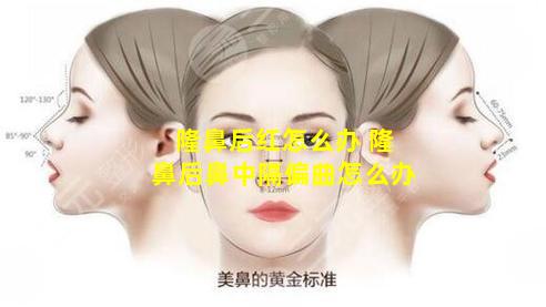 隆鼻后红怎么办 隆鼻后鼻中隔偏曲怎么办